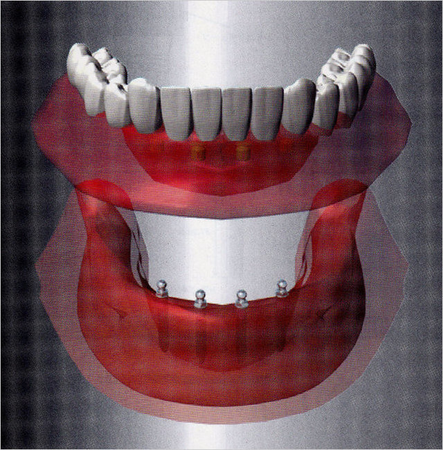 プラトンSD義歯.jpg