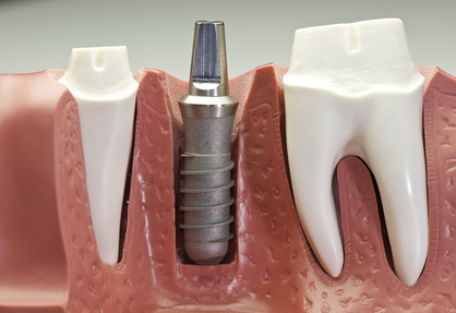 インプラントと天然歯と歯肉の関係