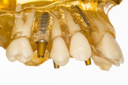 インプラント臼歯模型
