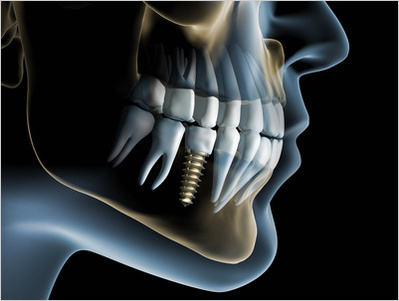 下顎奥歯のインプラントのイメージ