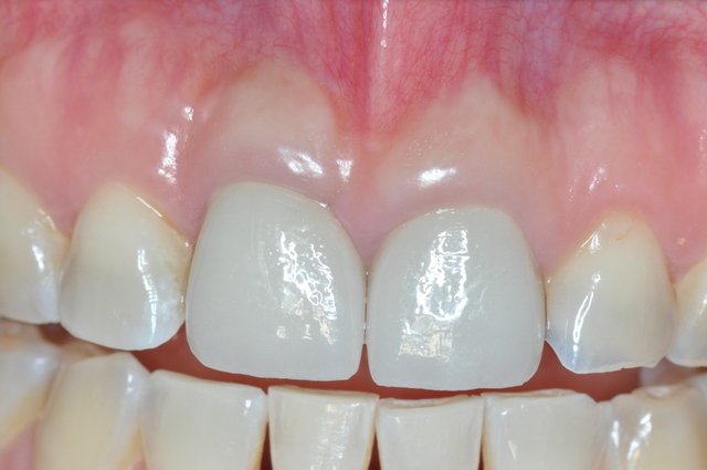 前歯のインプラントイメージ