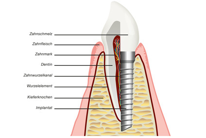 天然歯とインプラントの違いイメージ