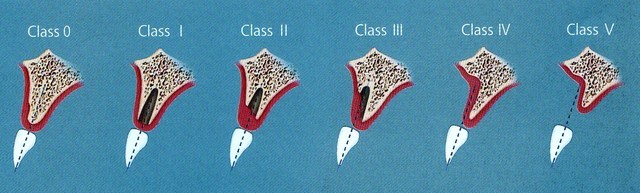 歯槽骨形状の変化