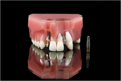 インプラントと歯の模型イメージ