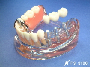 奥歯のインプラントと義歯のイメージ