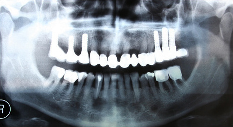 上顎奥歯のインプラントのイメージ