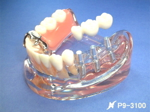 インプラントと義歯の模型