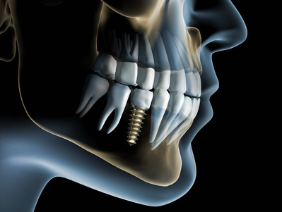 奥歯のインプラントイメージ
