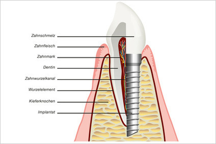 インプラントと天然歯のイメージ